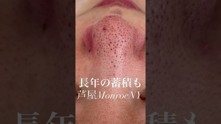 長年の蓄積も一回のエクストラクションで綺麗な毛穴になります